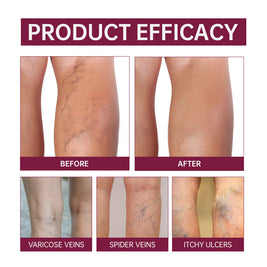 Varicose Vein Relief Cream - HaiyiBeauty